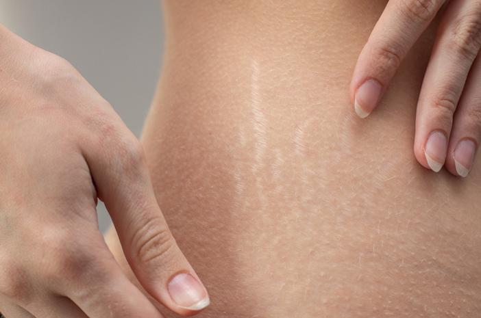 Microneedling RF Microneedling RF